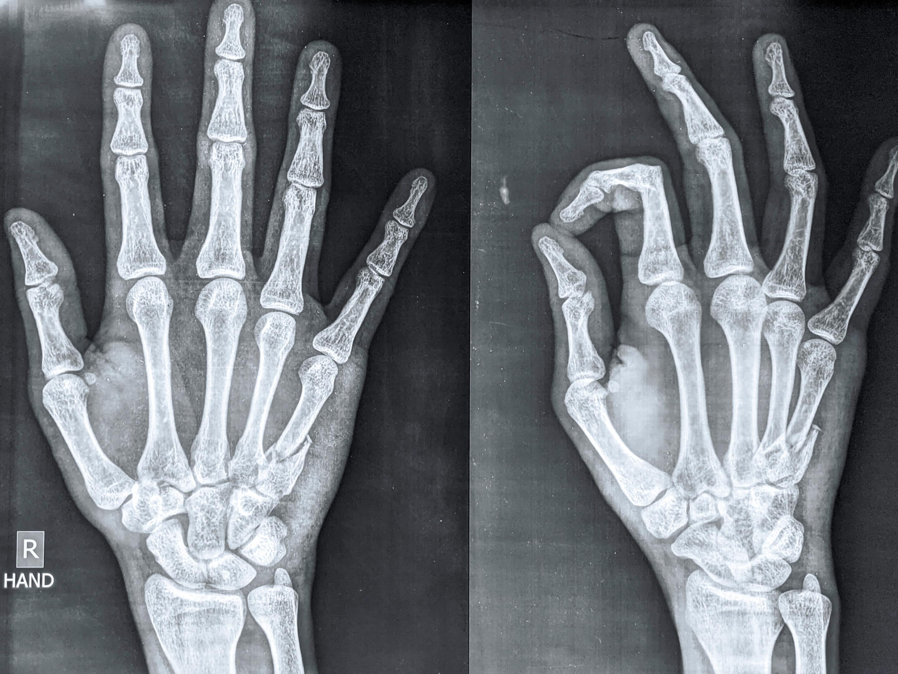 X ray of hand showing fifth metacarpal fracture, a common sport